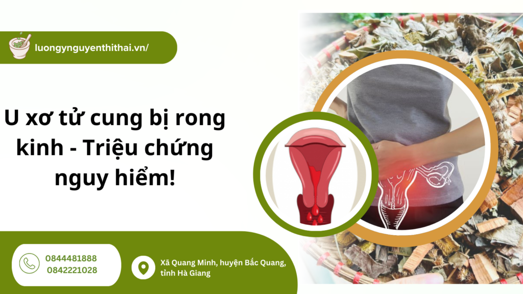 U xơ tử cung bị rong kinh