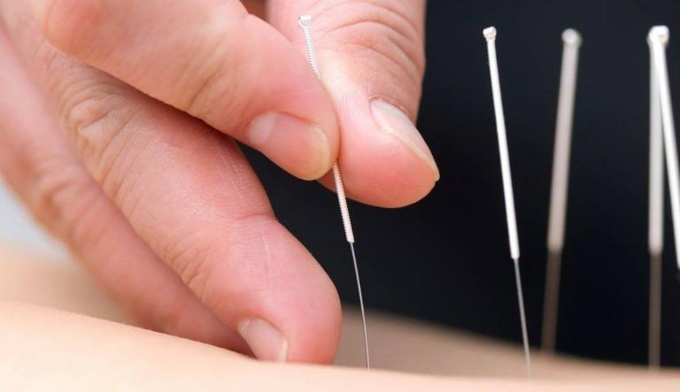 Châm cứu giúp điều trị lạc nội mạc tử cung