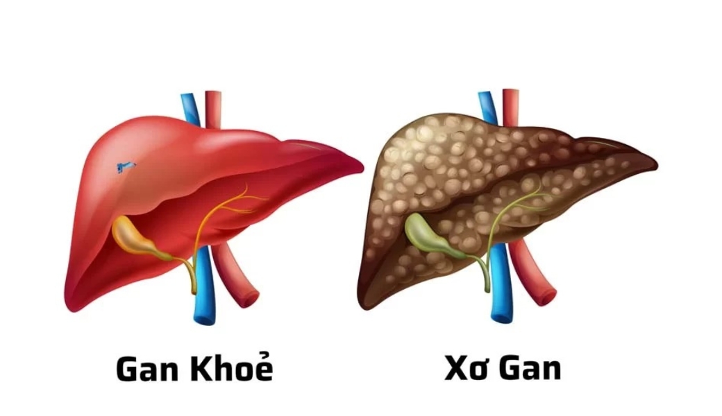 Bệnh nhân xơ gan cần được tầm soát để phát hiện và điều trị sớm