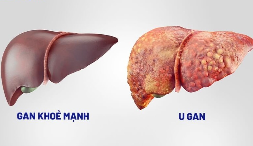 Sử dụng thuốc nam điều trị bệnh gan sẽ giúp giảm nguy cơ biến chứng và tái phát