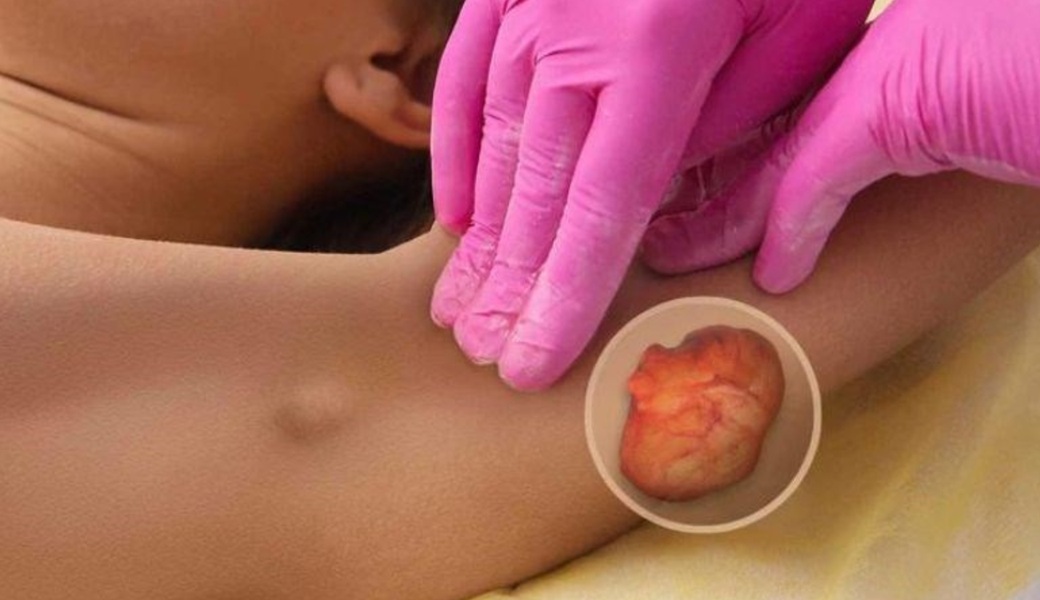 Bị u mỡ sẽ cảm nhận khối mềm dưới da, hình tròn hay hình bầu dục