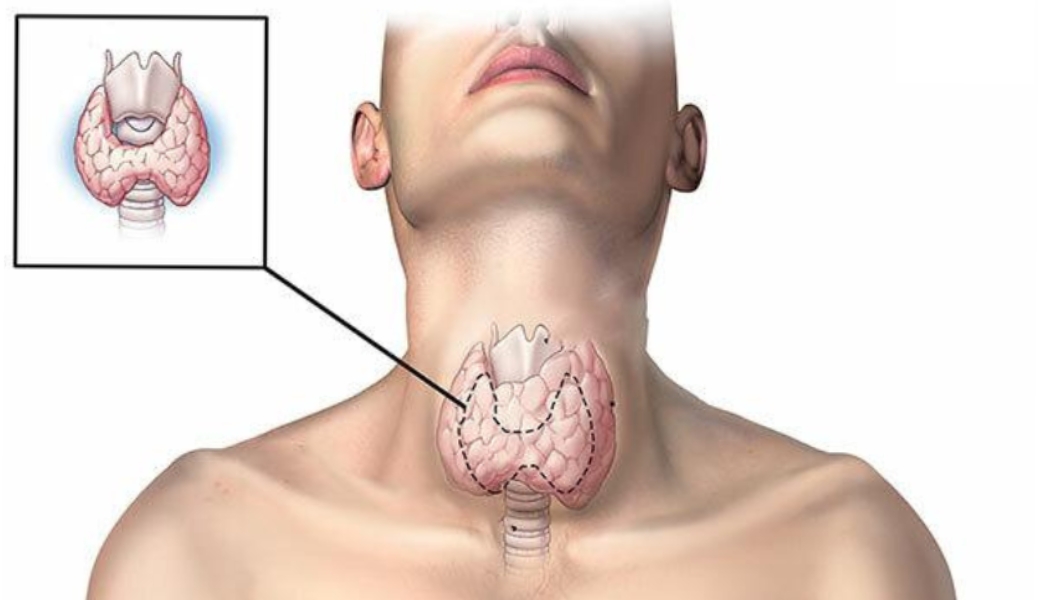 Cây thuốc nam chữa u tuyến giáp có thật sự hiệu quả?