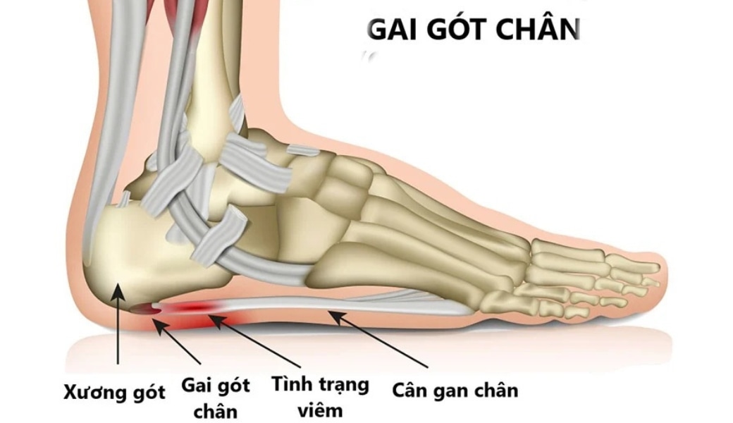 Nguyên nhân dẫn đến gai gót chân có thể do viêm cân gan chân