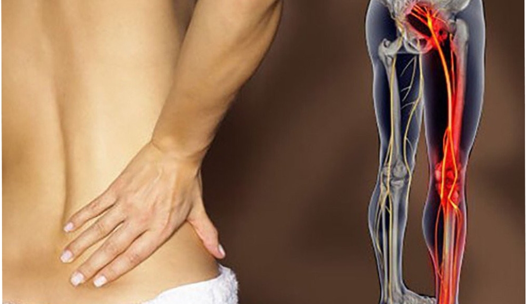 Nguyên nhân dẫn đến triệu chứng đau thần kinh tọa?