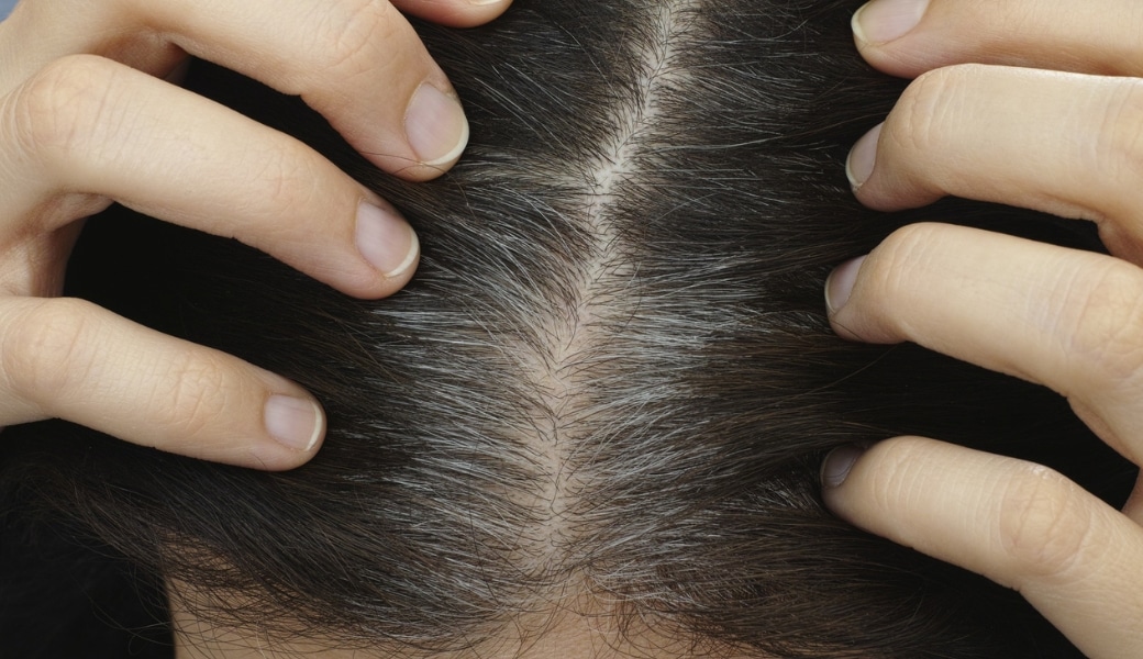 Tóc bạc sớm do nhiều nguyên nhân gây ra