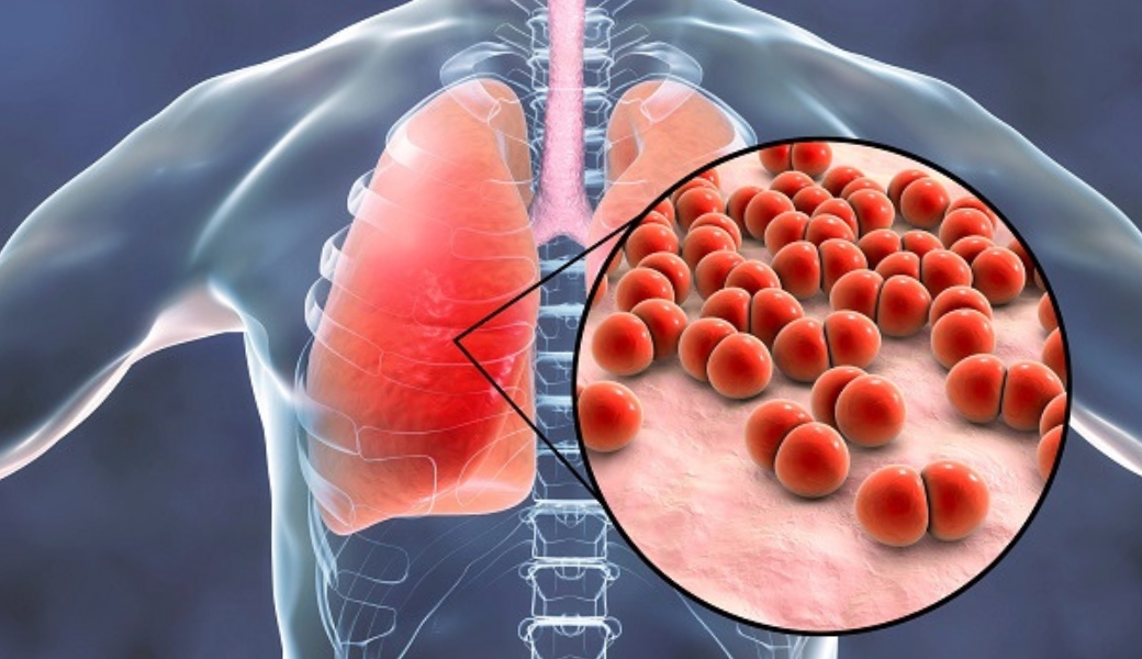 Viêm phổi gây ra nhiều bệnh lý cho người bệnh