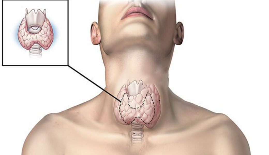 chữa bướu cổ bằng cây thuốc nam