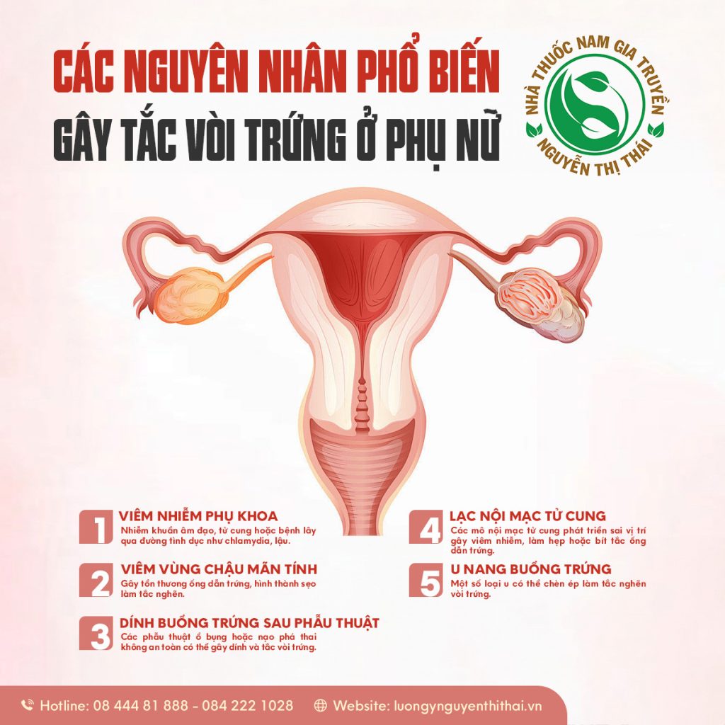 Các nguyên nhân phổ biến gây tắc vòi trứng ở phụ nữ.