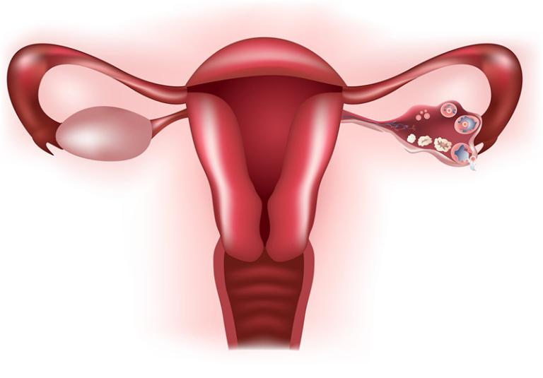 Tổng quan về tắc vòi trứng và mối liên hệ với khả năng sinh sản