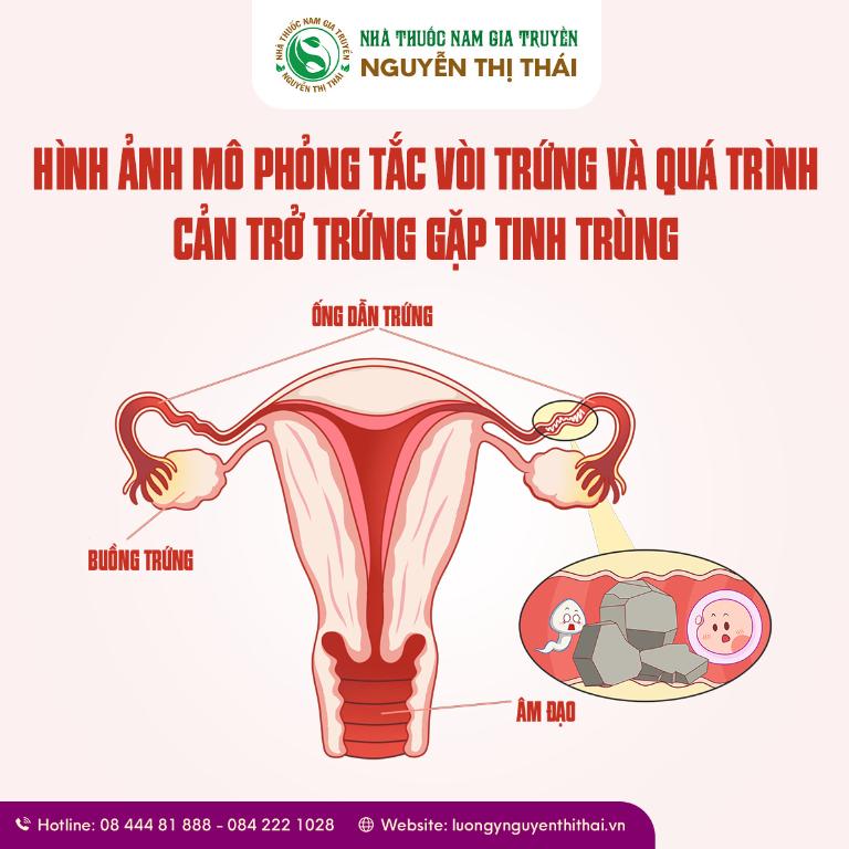 Nguyên nhân tắc vòi trứng
