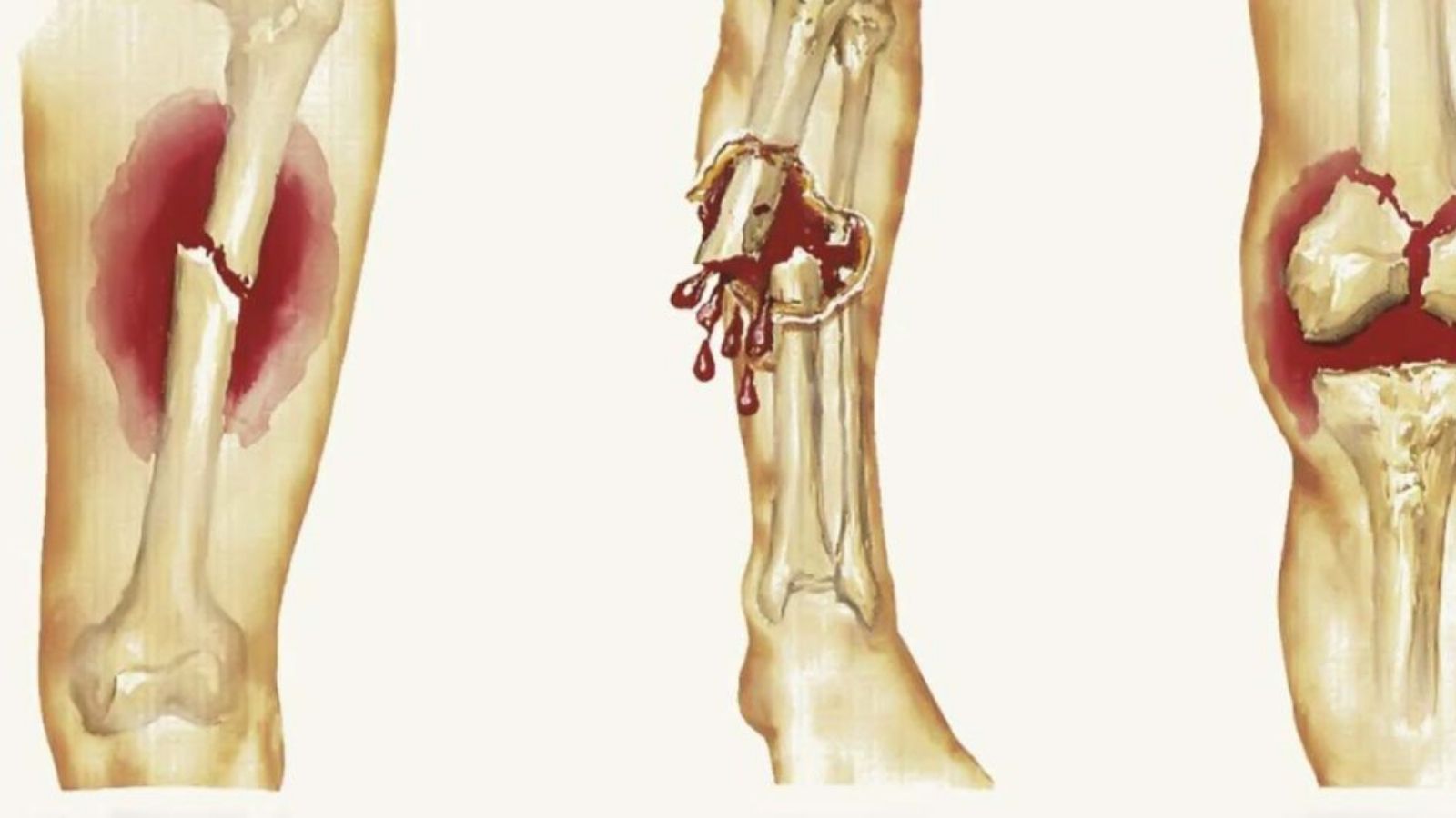 bai-thuoc-nam-tri-ung-thu-xuong