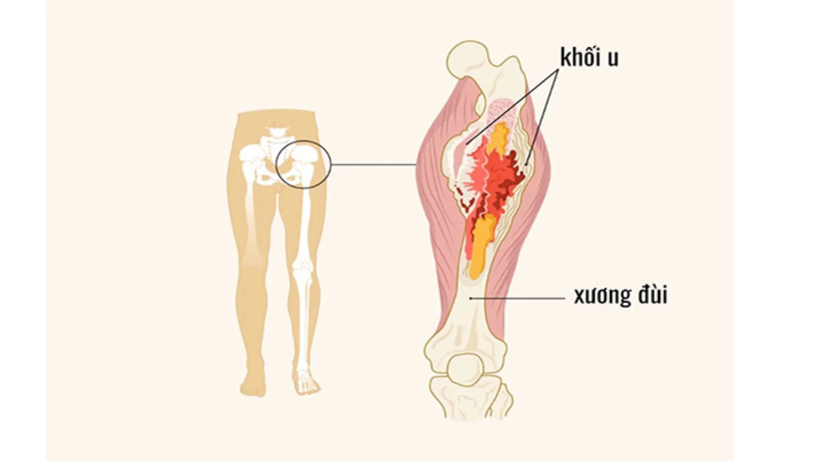 bai-thuoc-nam-tri-ung-thu-xuong