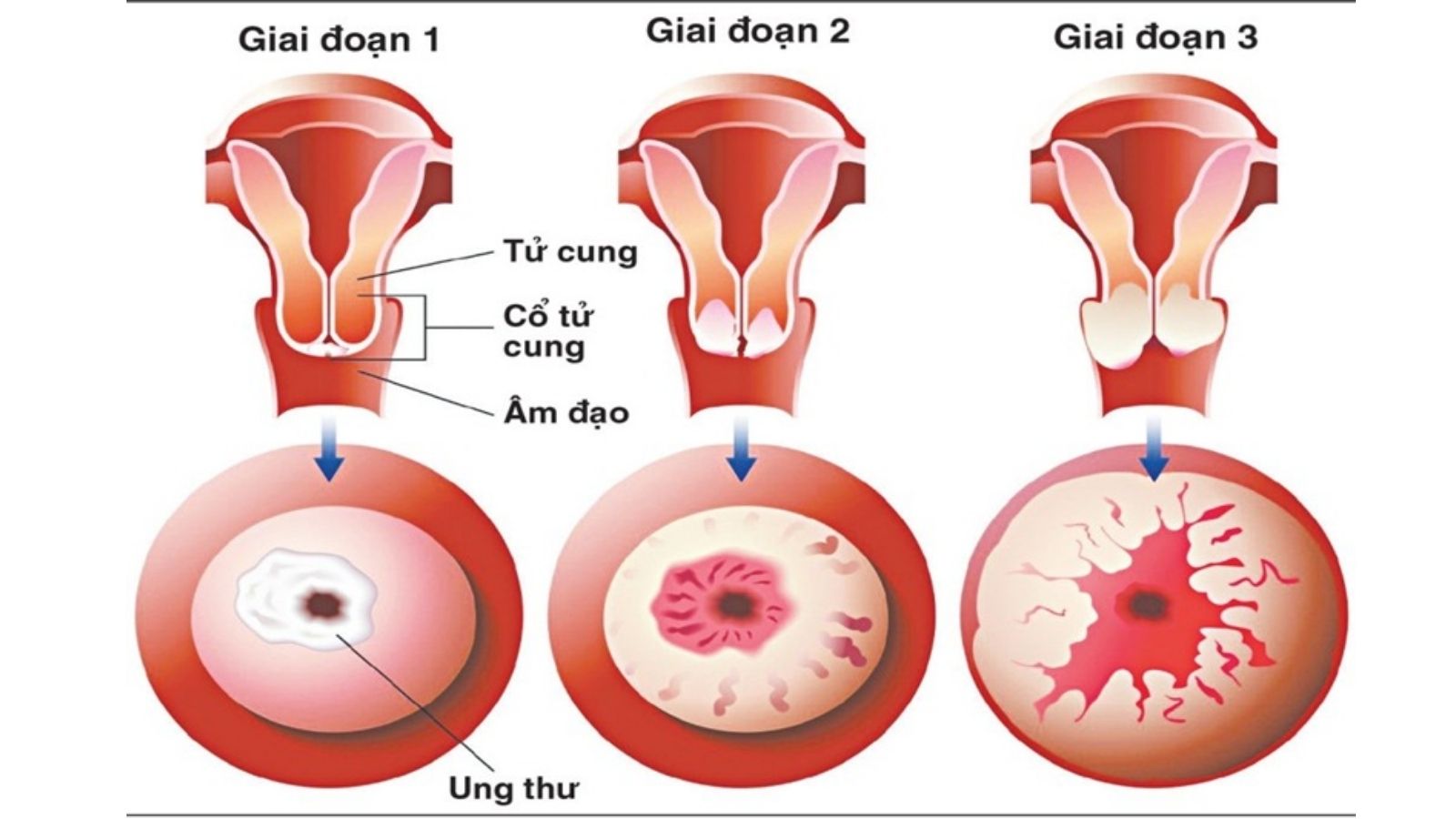 cay-thuoc-nam-tri-ung-thu-co-tu-cung