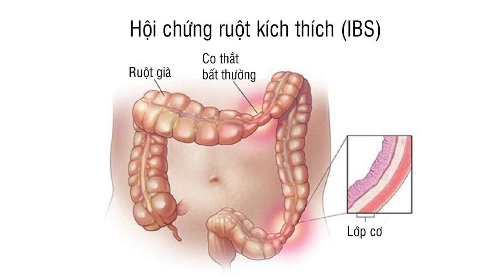 thuoc-nam-chua-hoi-chung-ruot-kich-thich