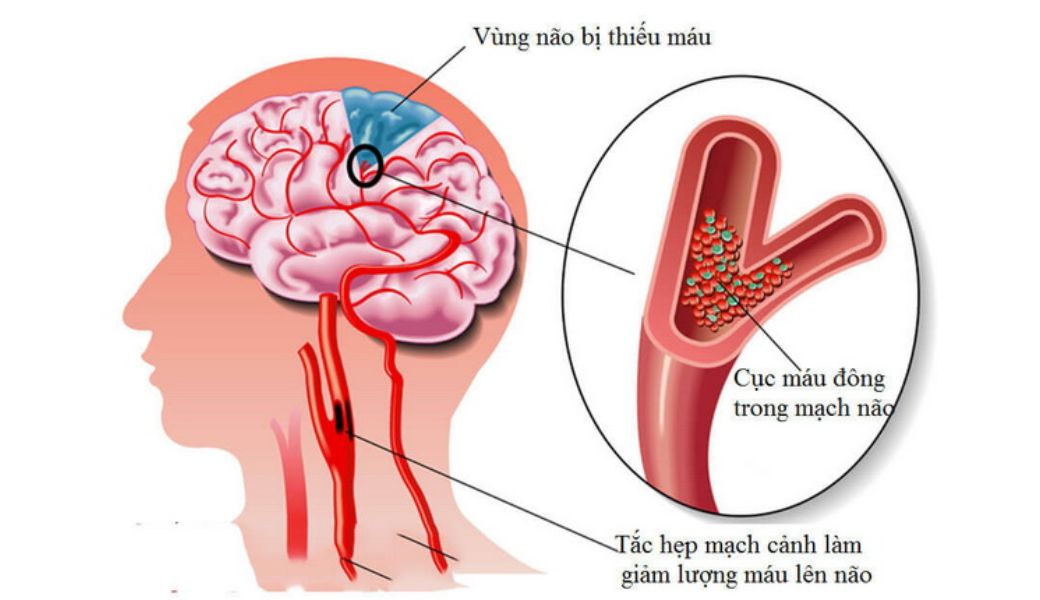 bai-thuoc-dan-gian-chua-thieu-mau-nao