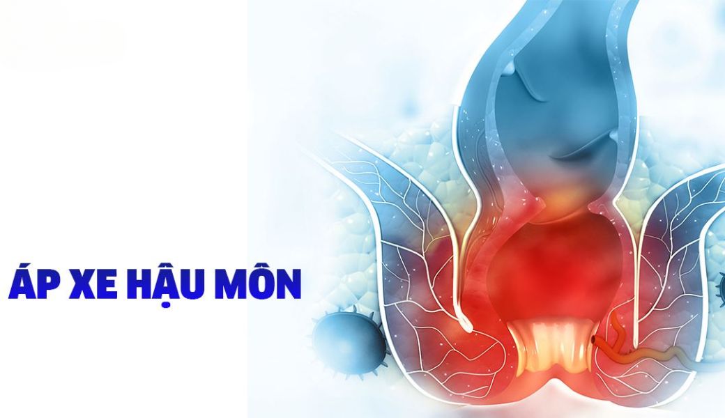 bai-thuoc-dan-gian-tri-ap-xe-hau-mon