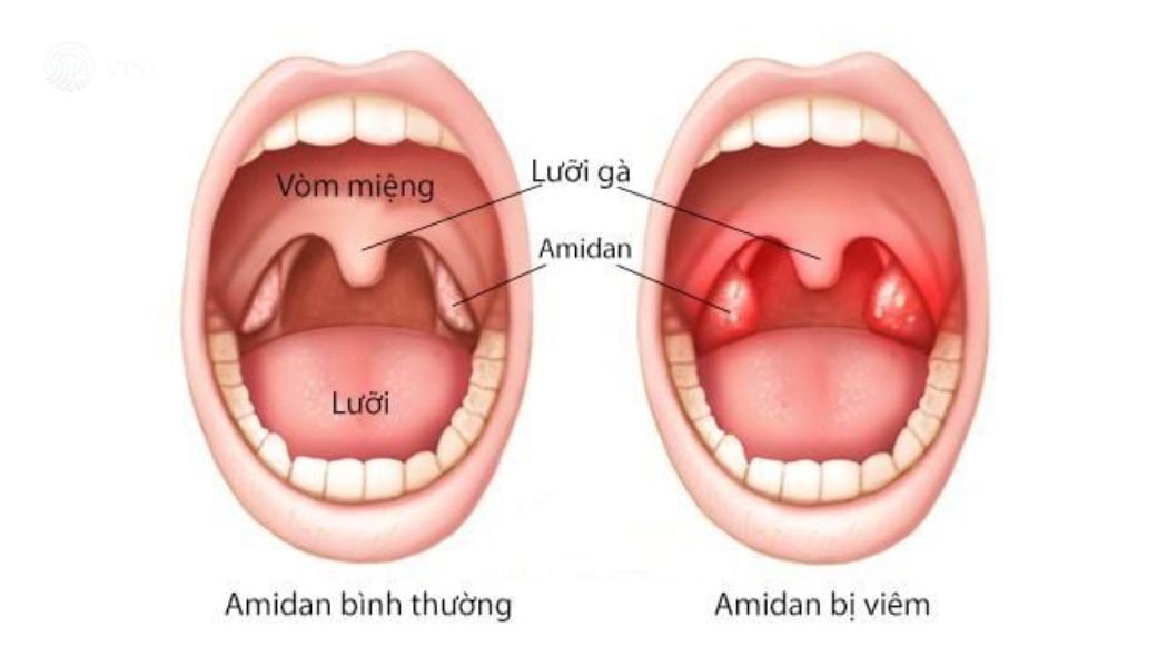 chua-amidan-bang-thuoc-nam