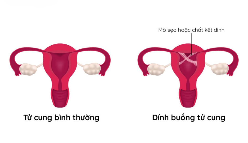 lam-sao-de-biet-dinh-buong-tu-cung