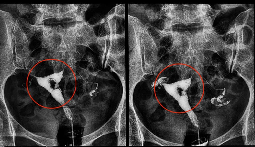 lam-sao-de-biet-dinh-buong-tu-cung