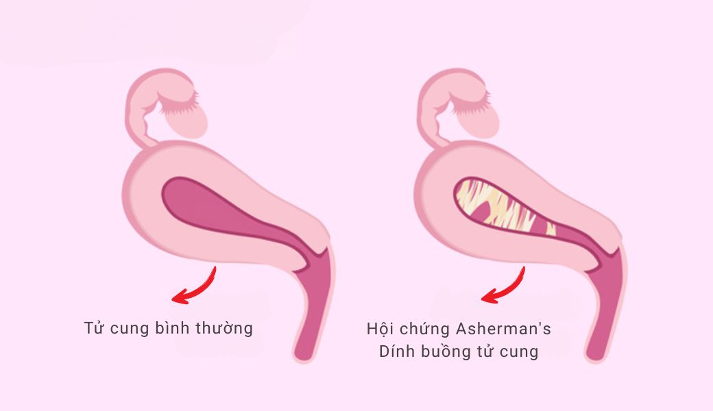 lam-sao-de-biet-dinh-buong-tu-cung