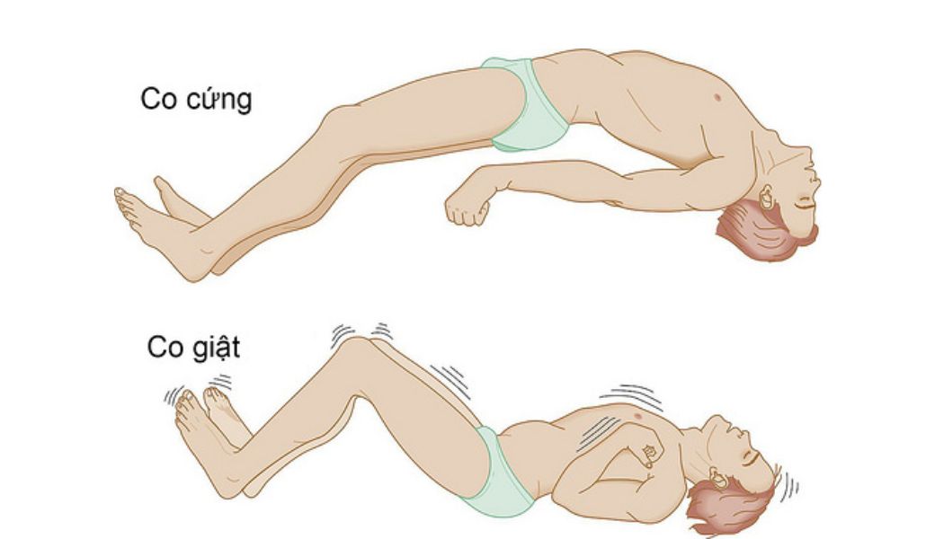 nhung-bai-thuoc-nam-chua-benh-dong-kinh