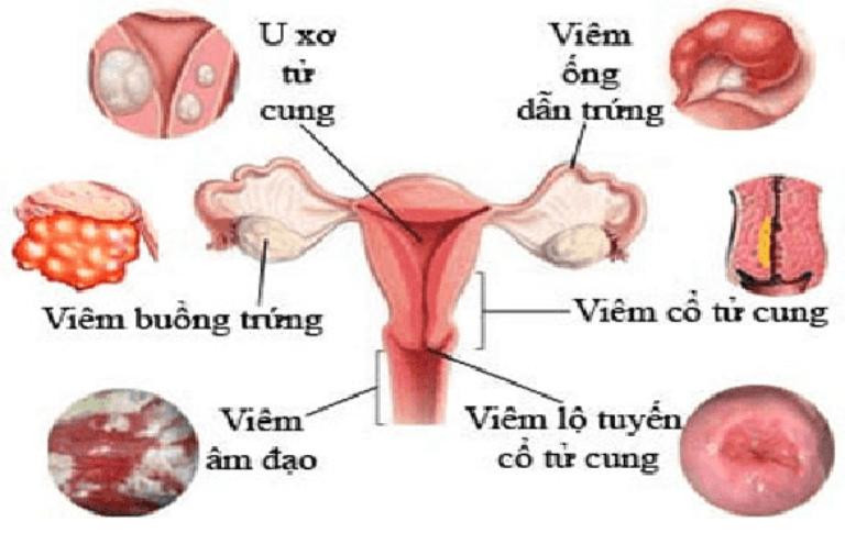 Top 5 Bệnh Phụ Khoa Nữ Phổ Biến Nhất