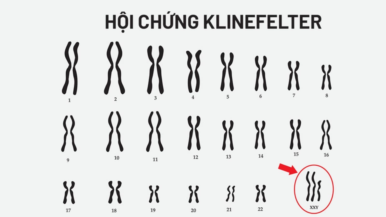 Các yếu tố di truyền gây vô sinh ở nam giới