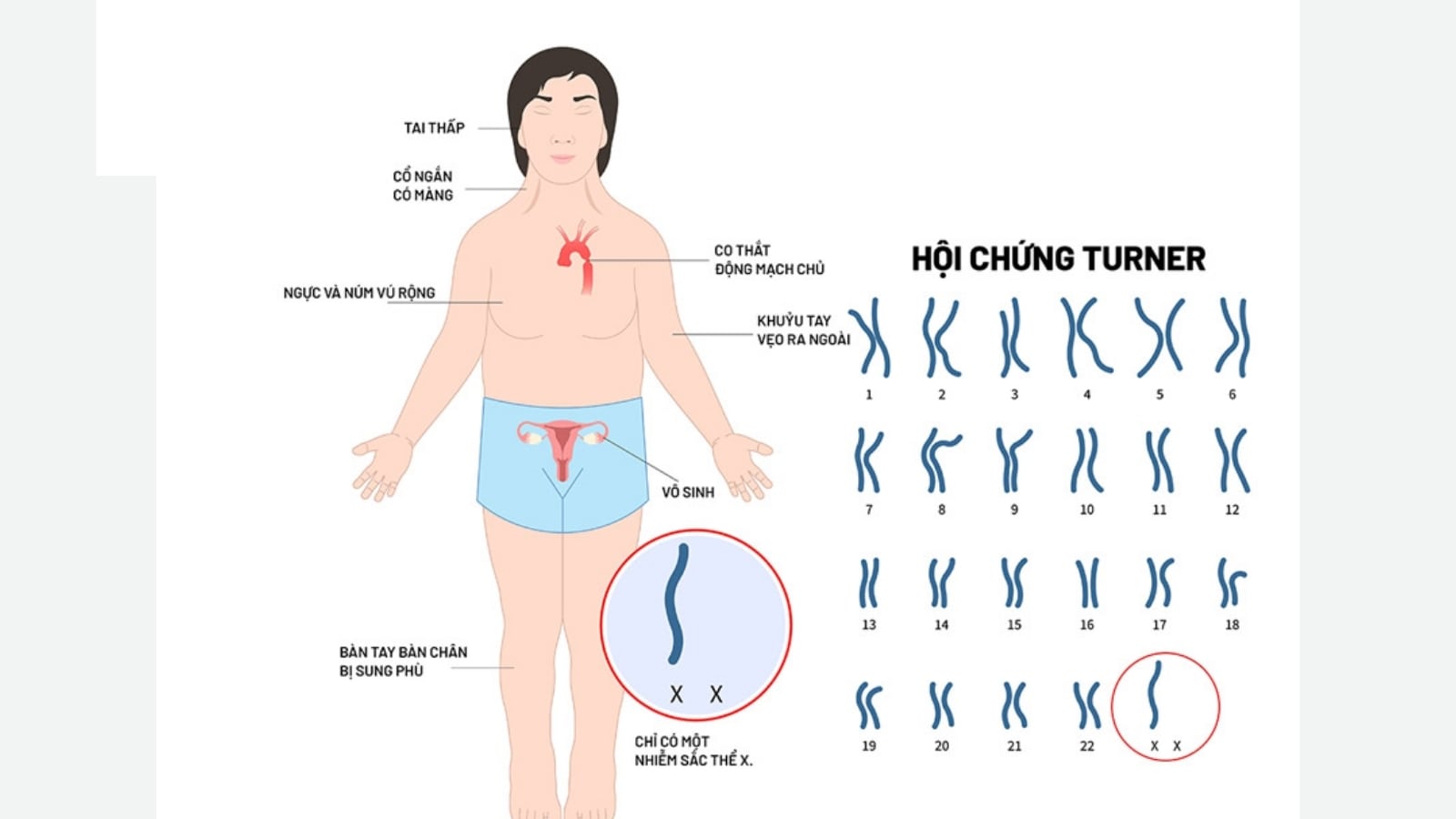 Các yếu tố di truyền gây vô sinh ở nữ giới