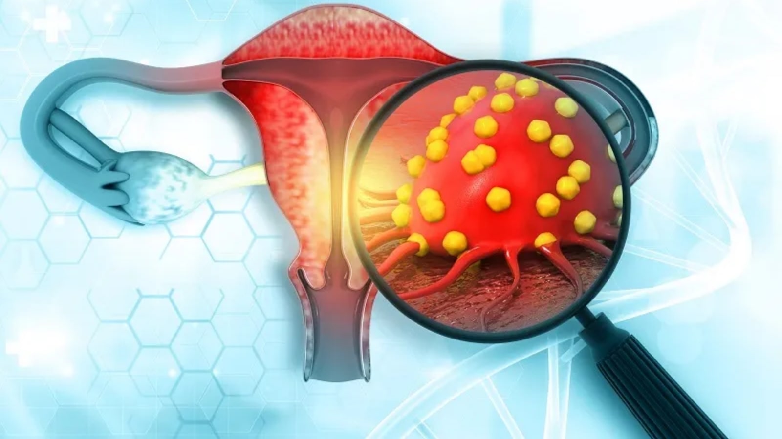 bị đa nang buồng trứng có nguy hiểm không