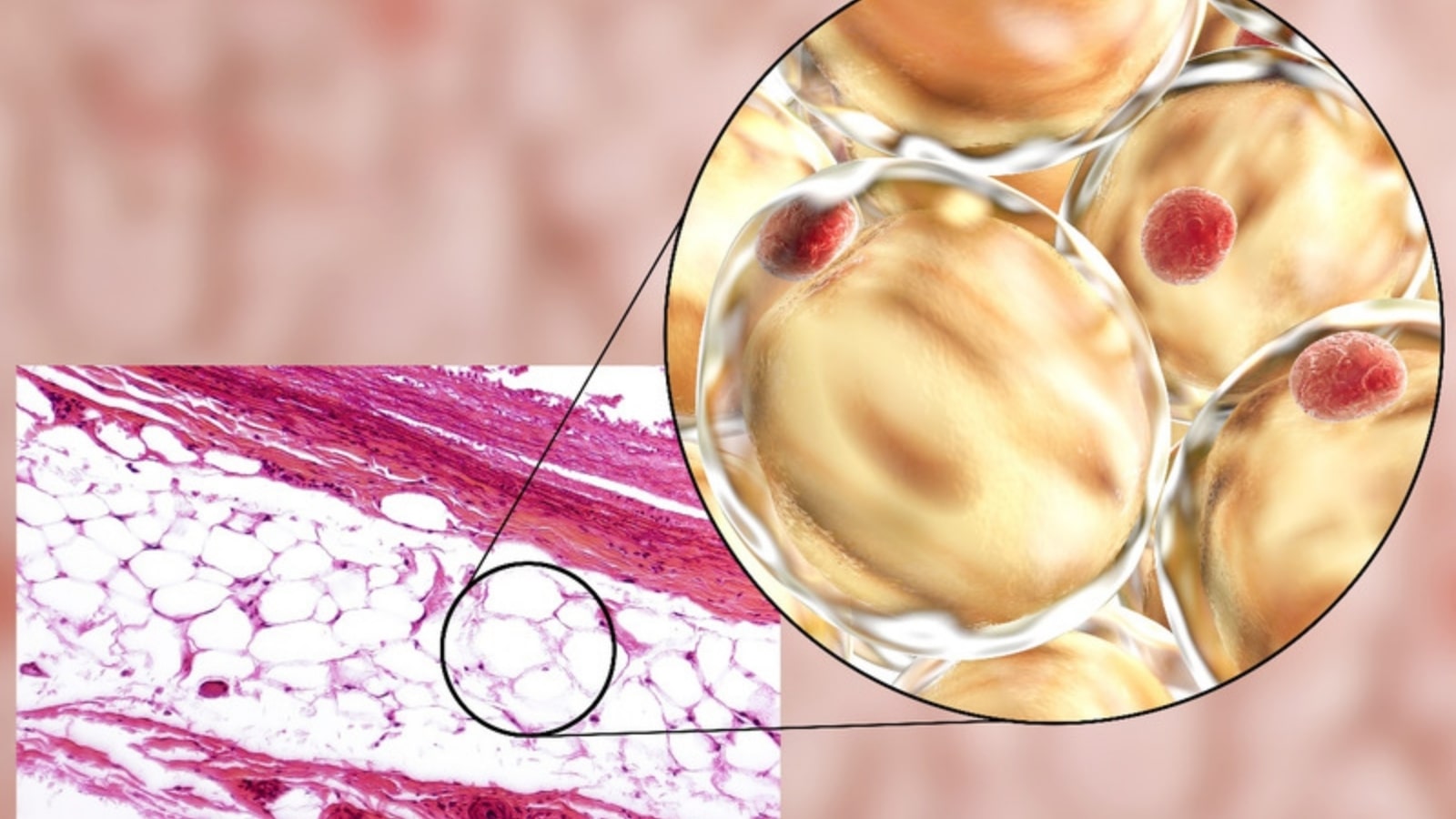 bị đa nang buồng trứng có nguy hiểm không