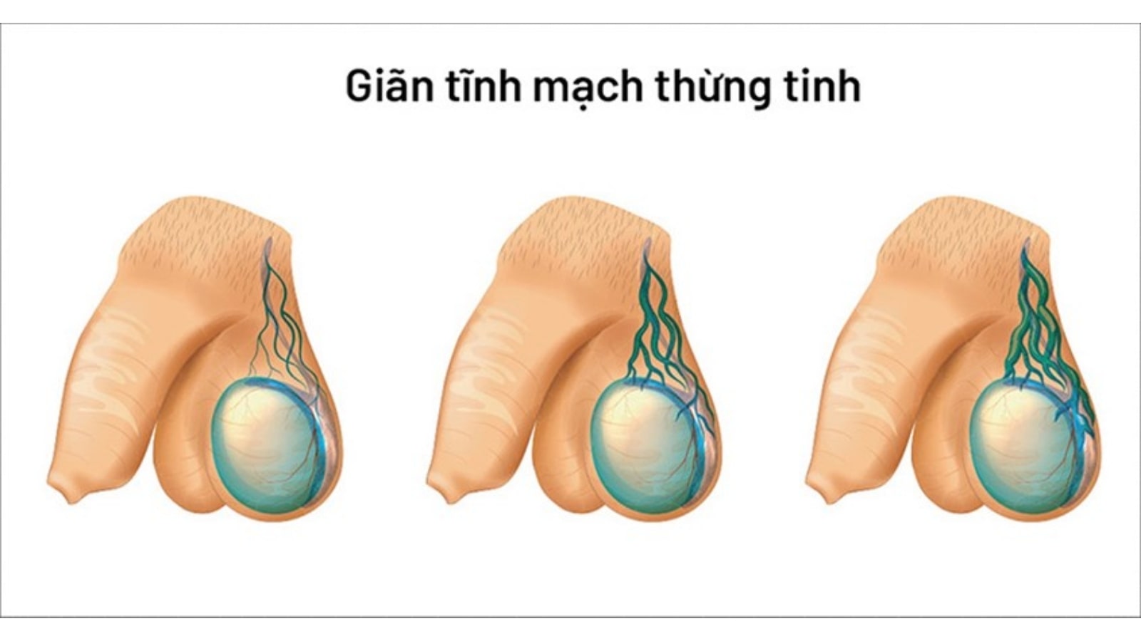Giãn tĩnh mạch tinh hoàn là nguyên nhân phổ biến gây vô sinh ở nam giới.