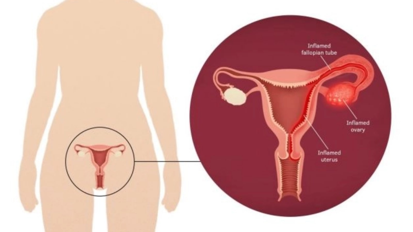 Quai bị tấn công hệ sinh sản nữ giới như thế nào
