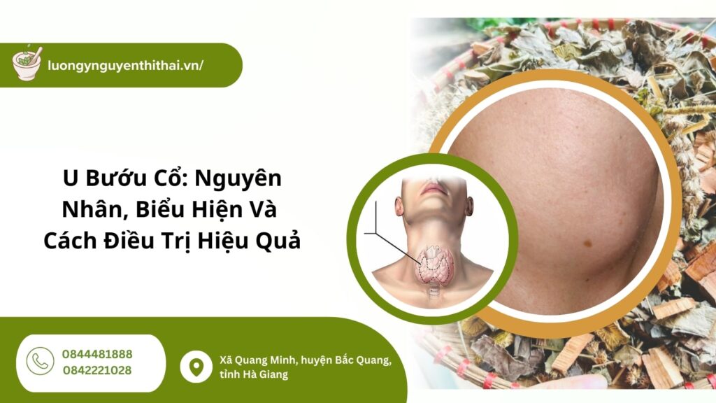 u bướu cổ