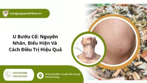 u bướu cổ