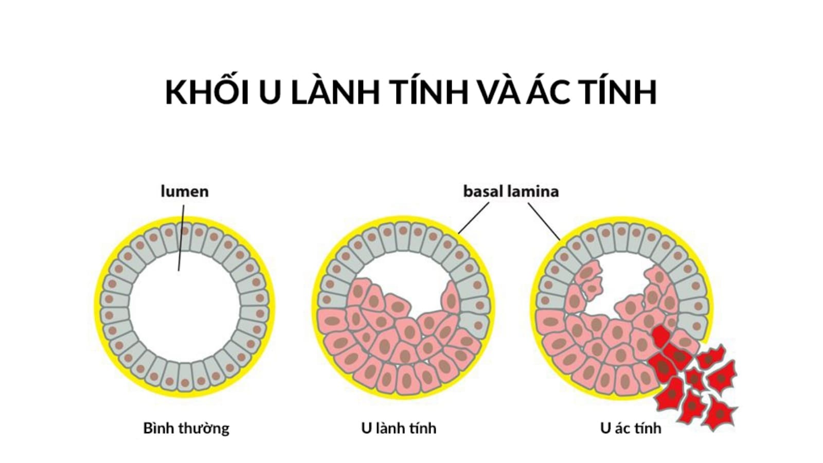 u bướu là gì