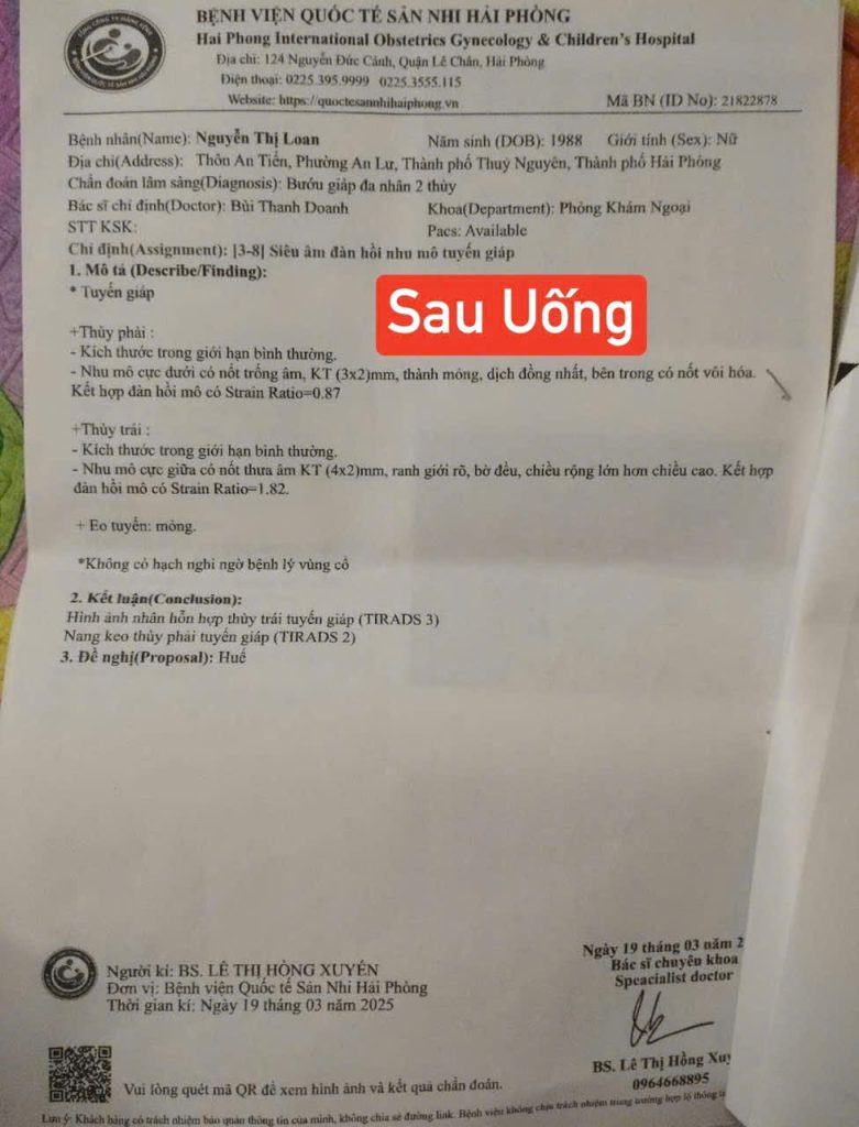 (sau điều trị – tháng 03/2025): Kết quả siêu âm cho thấy nhân tuyến giáp giảm rõ rệt – thùy phải chỉ còn 3×2mm, thùy trái 4×2mm, mô tuyến đều, không phát hiện bất thường mới.