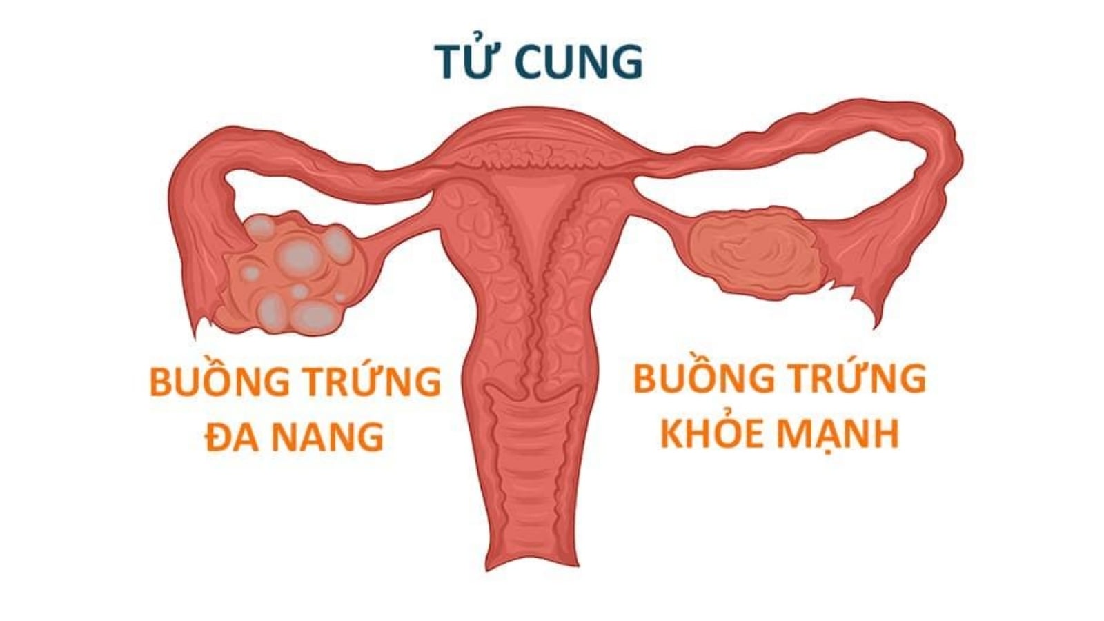 buồng trứng đa nang có chữa được không