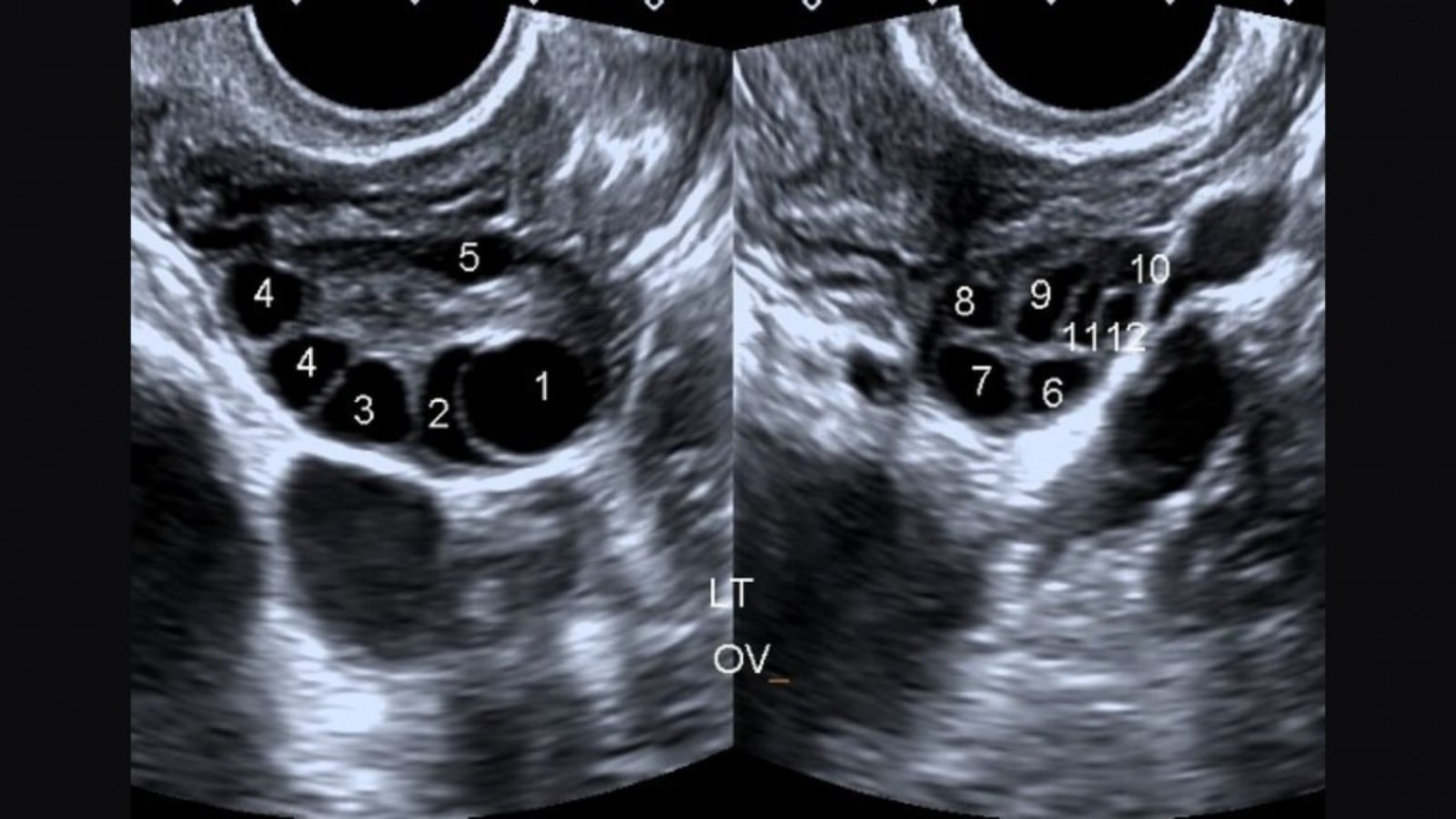 buồng trứng đa nang có chữa được không
