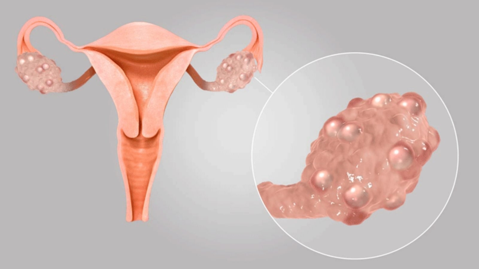 buồng trứng đa nang làm sao để có con