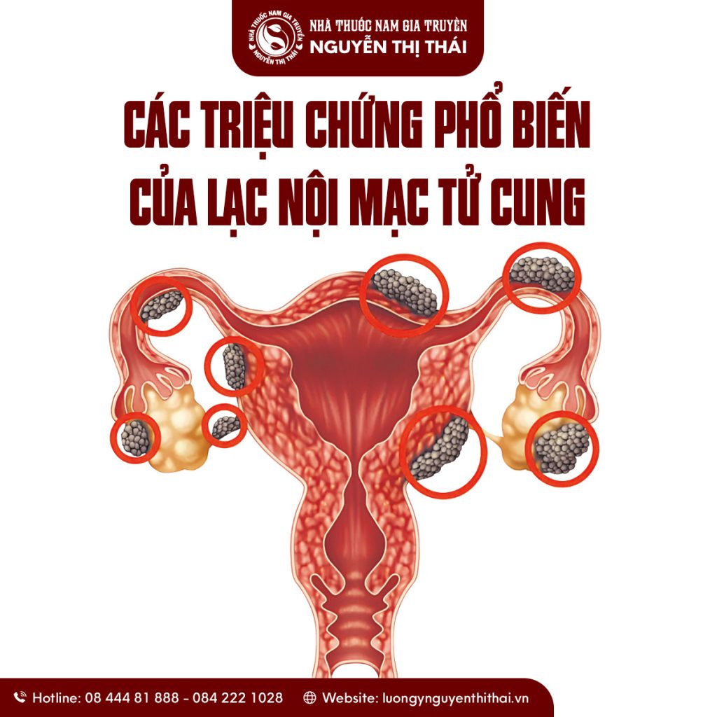 “Lạc nội mạc tử cung khiến mô tử cung đi lạc, gây đau và cản trở quá trình thụ thai.”