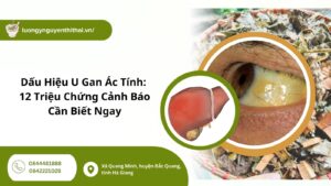 Dấu Hiệu U Gan Ác Tính