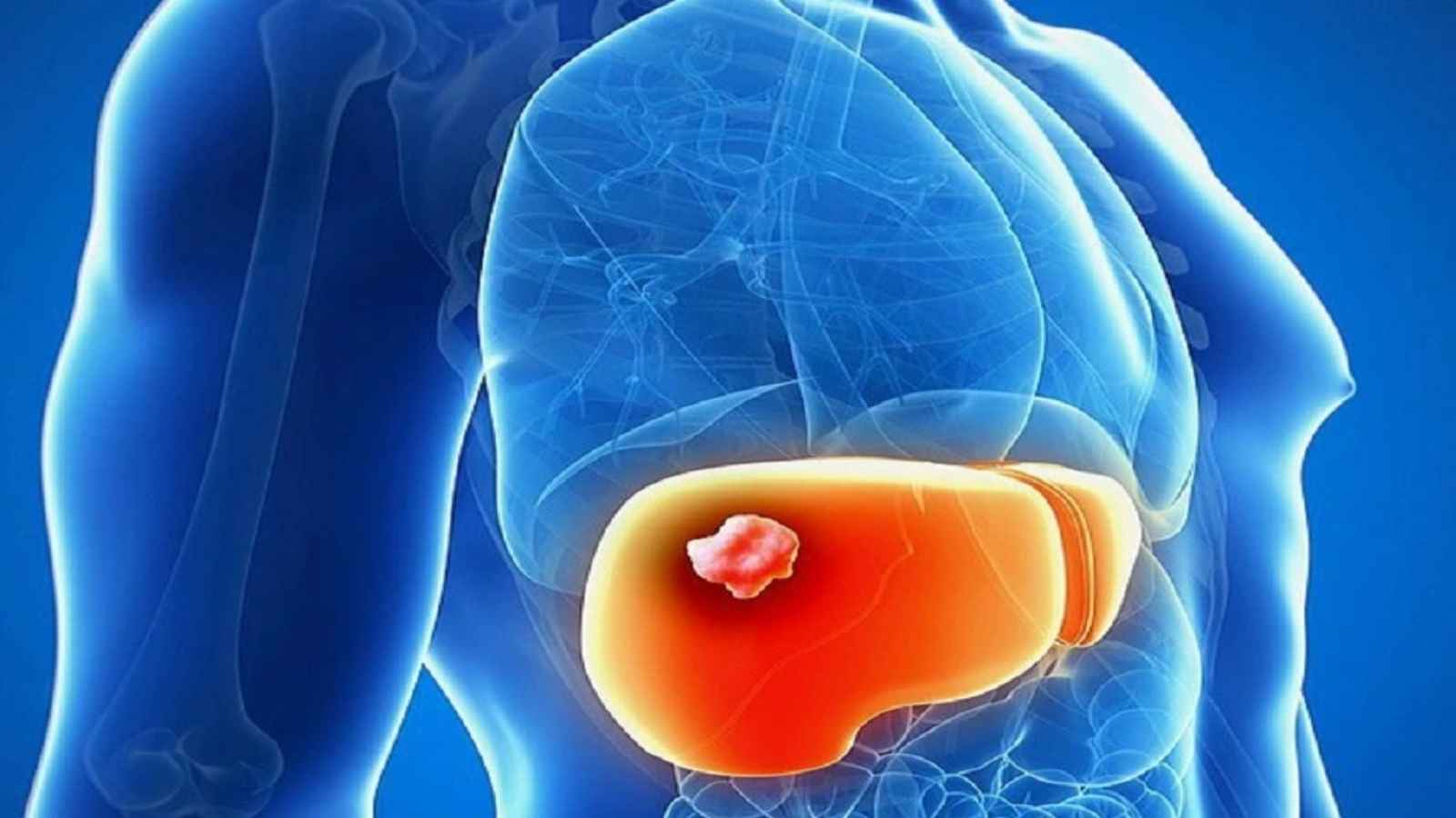 Dấu Hiệu U Gan Ác Tính