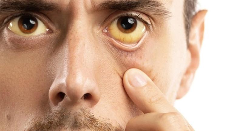 Biểu hiện da và dịch mật sớm: vàng da nhẹ, ngứa, nước tiểu sẫm màu thoáng qua