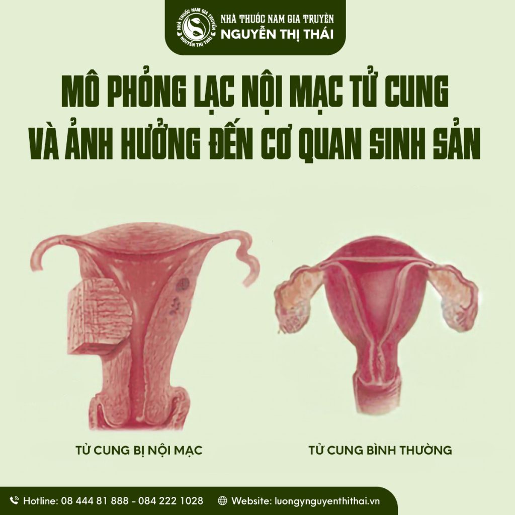 “Cơn đau bụng dưới tái phát hàng tháng – dấu hiệu điển hình của lạc nội mạc tử cung.”