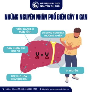 Những nguyên nhân phổ biến gây u gan mà nhiều người không ngờ tới.