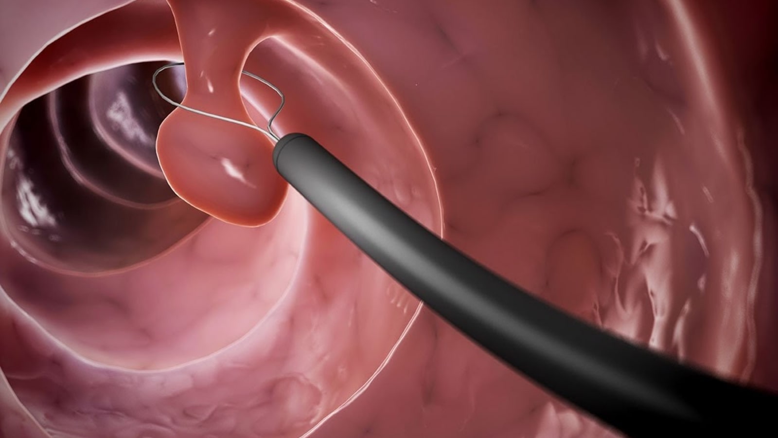 U Đại Tràng Sigma Là Gì