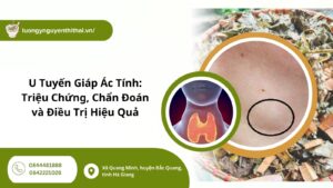 U Tuyến Giáp Ác Tính