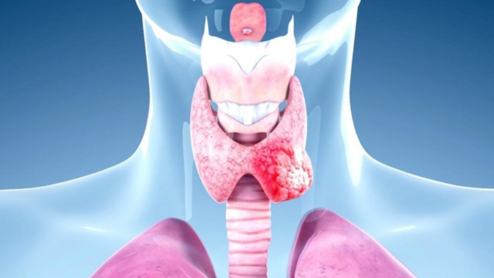 U Tuyến Giáp Ác Tính