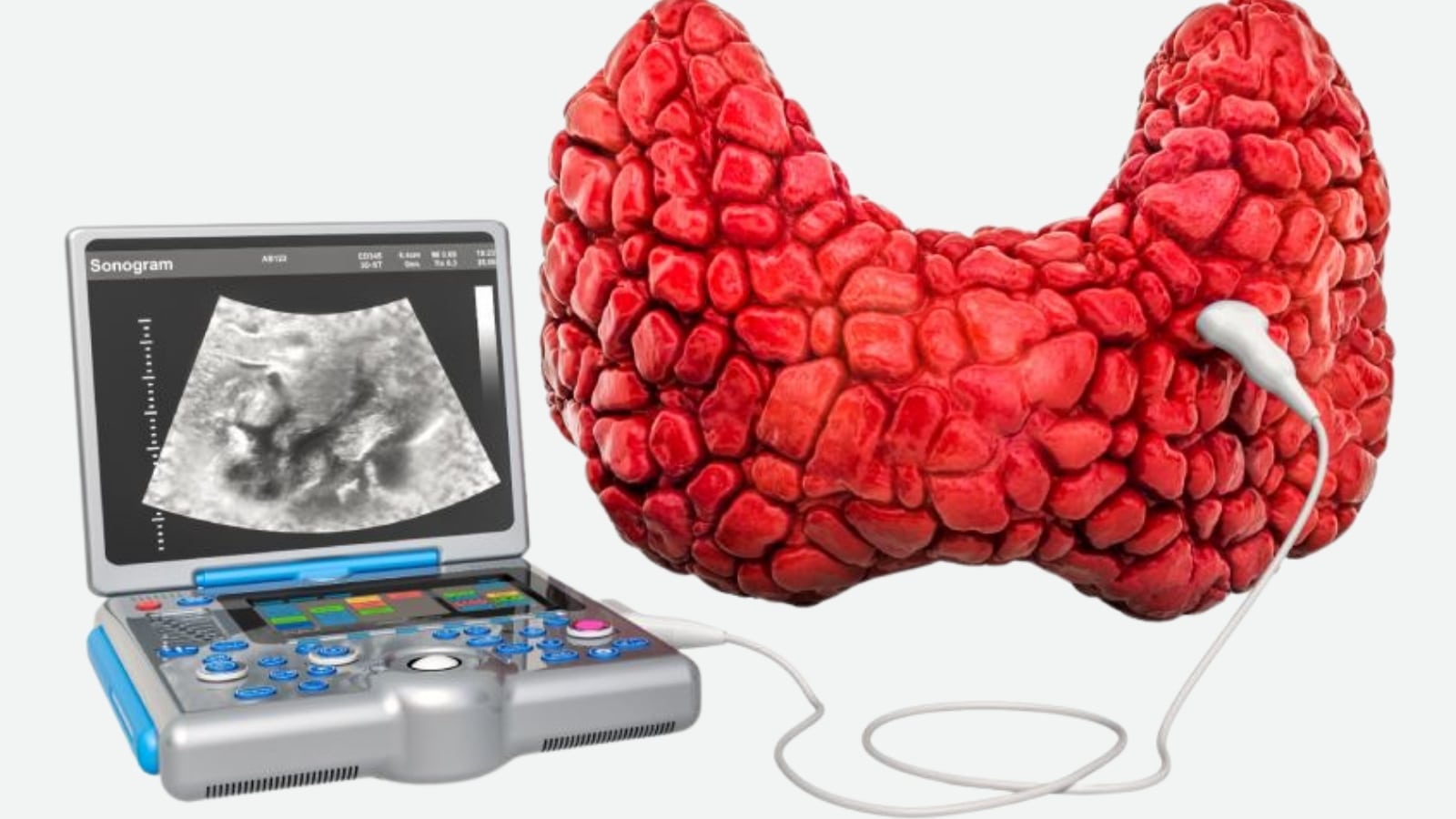 U Tuyến Giáp Ác Tính