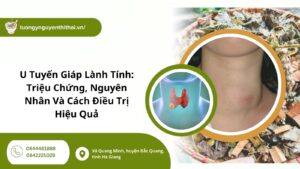 u tuyến giáp lành tính